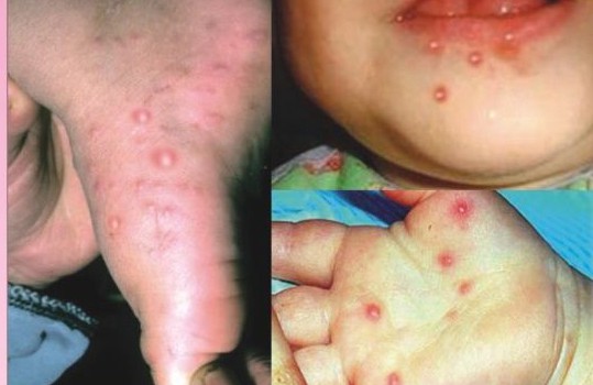 Dịch chân tay miệng kề cận dịch sốt xuất huyết dich chan tay mieng
